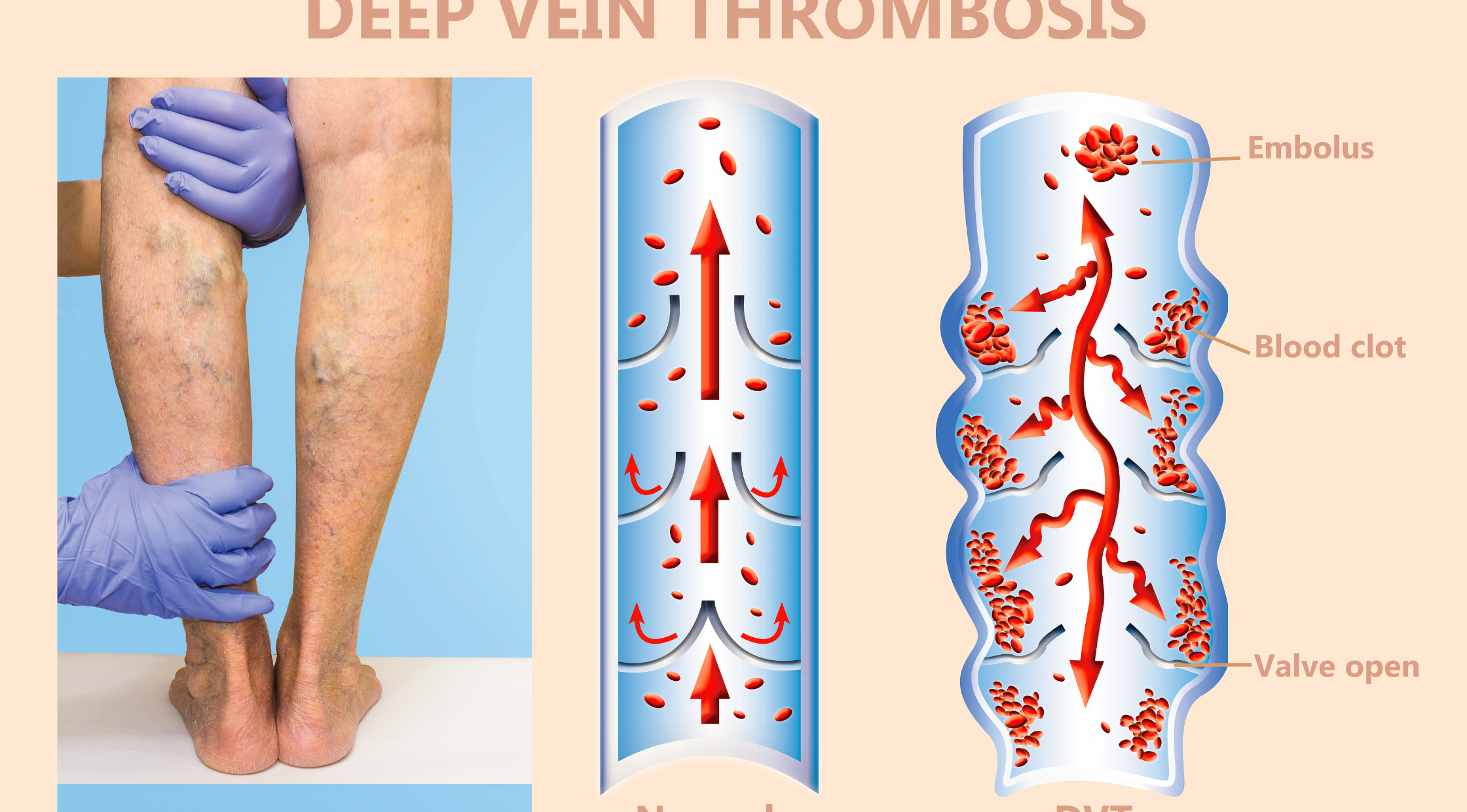 Vein Meaning in Tamil